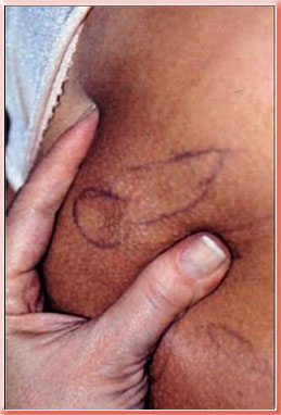 [cellulite1.jpg]