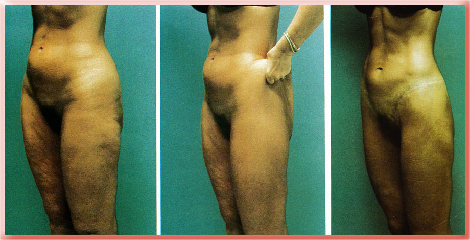 [cellulite-lift.jpg]