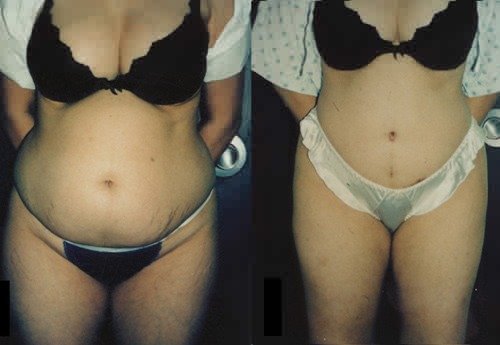 [abdplasty1.JPG]