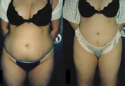 abdominoplasty for stretchmarks