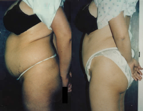 [abdplasty2.JPG]