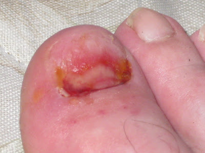 big big toe