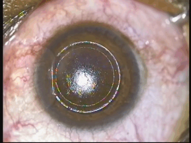 [figure7lenticlecompletelyremoved.gif]