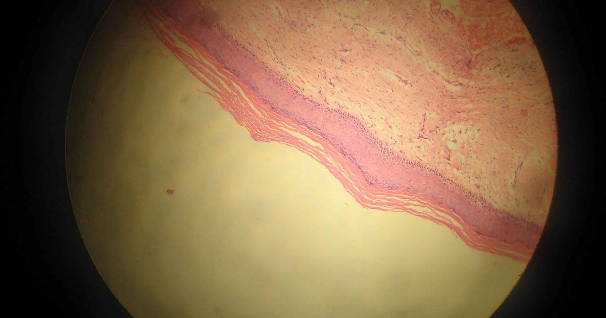 dentalaka Orthokeratinized odontogenic kerato cyst