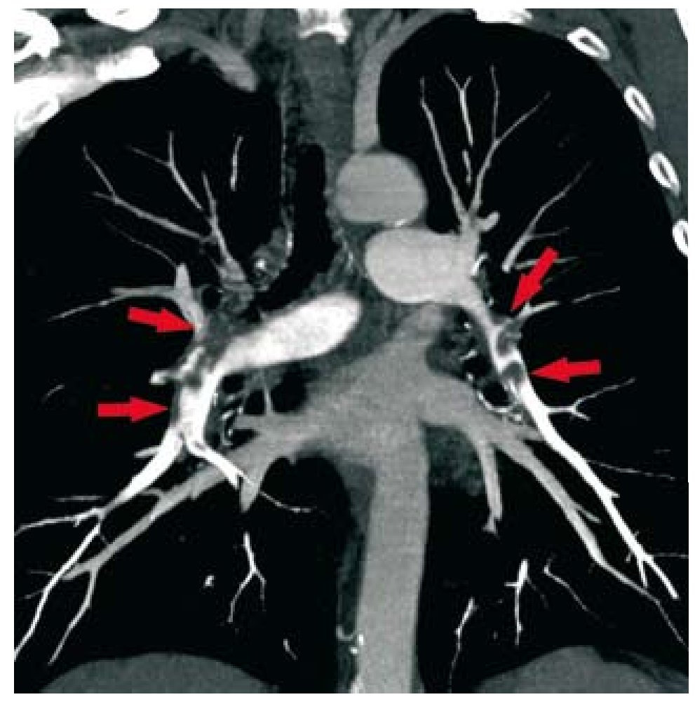 spiral ct angiography pulmonary embolism