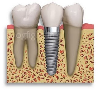 [implante-dental.jpg]