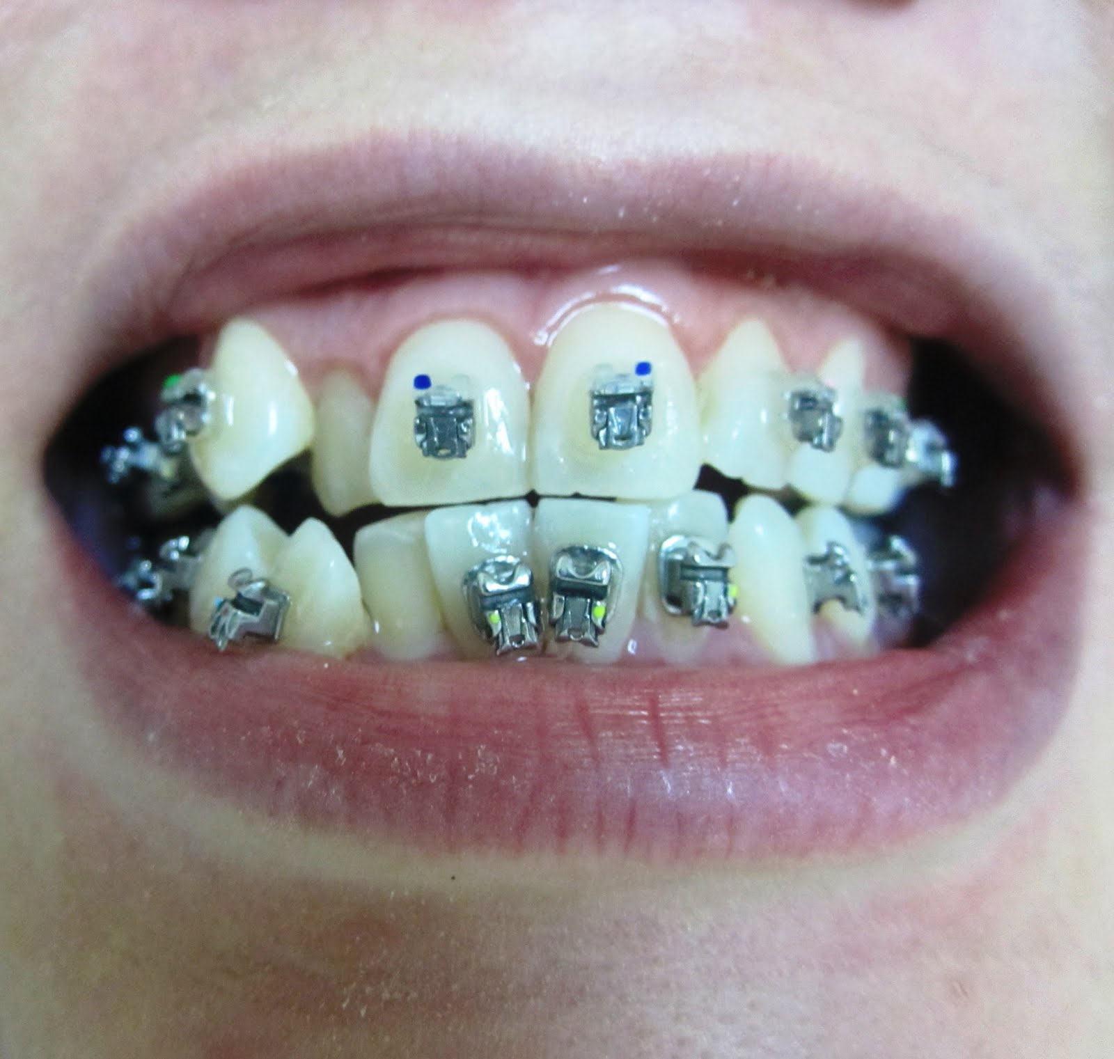 Rubber Band Teeth