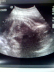 Baby A (spine on top, head to lower right)