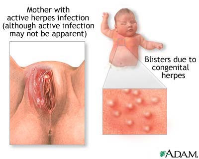 Steroid treatment for croup in babies