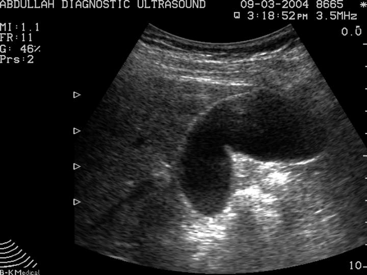 Gall Bladder