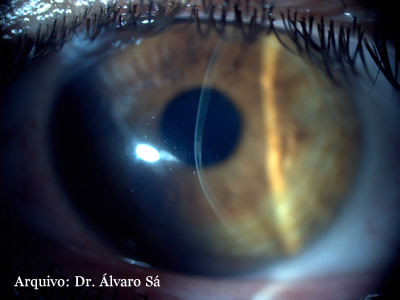 [pat_cornea2.jpg]