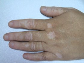 [vitiligo.jpg]