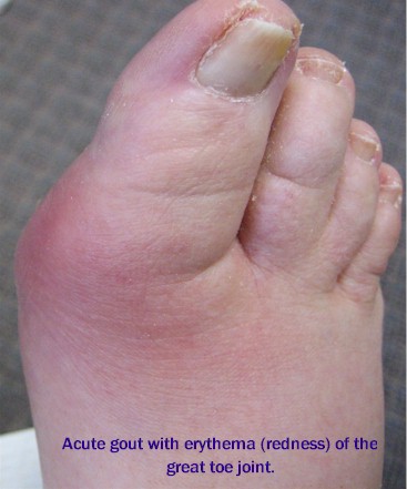 penyakit gout