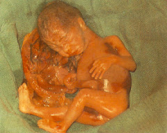 Aborto por envenamiento salino