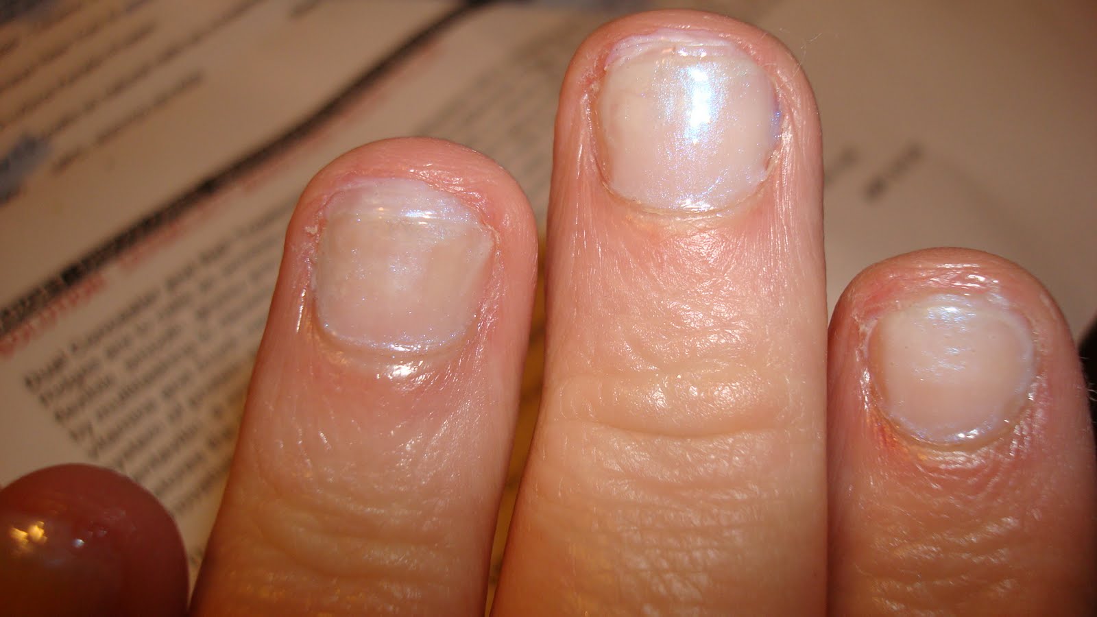 Pale Fingernail Beds