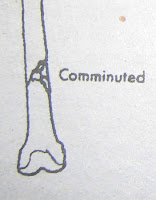 anatomy and physiology: Types of Fractures