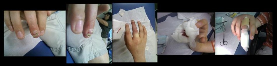 [Elliotts+Nail+Removed+(Large).jpg]