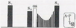 from atrial kick. Others: