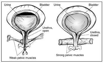 Illustration showing comparison of weak pelvic muscles and strong pelvic muscles.