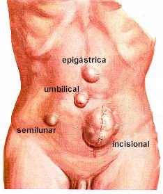 [hernia-types-2.bmp]