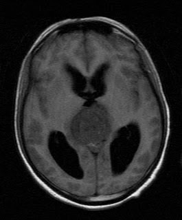 pineal tumour
