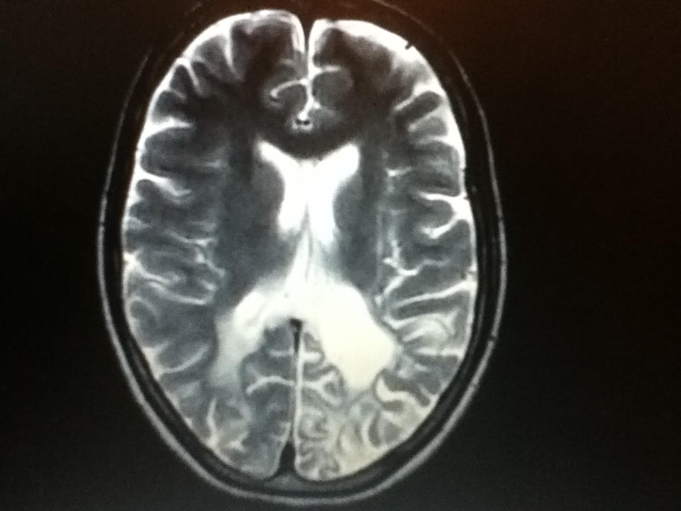 HIV encephalopathy and AIDS dementia complex