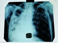 [media\tuberculosis.jpg]