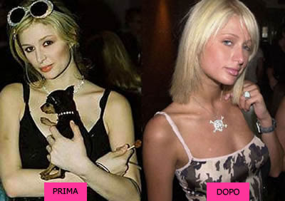 Paris Hilton prima e dopo la rinoplastica