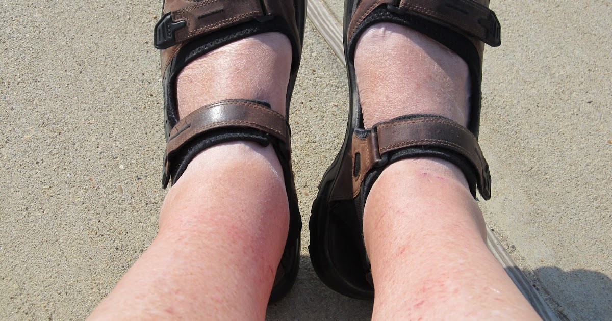 PrunePicker: extreme fatigue and swollen itchy ankles