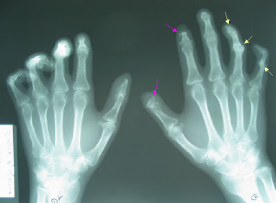 but erosive arthropathy is