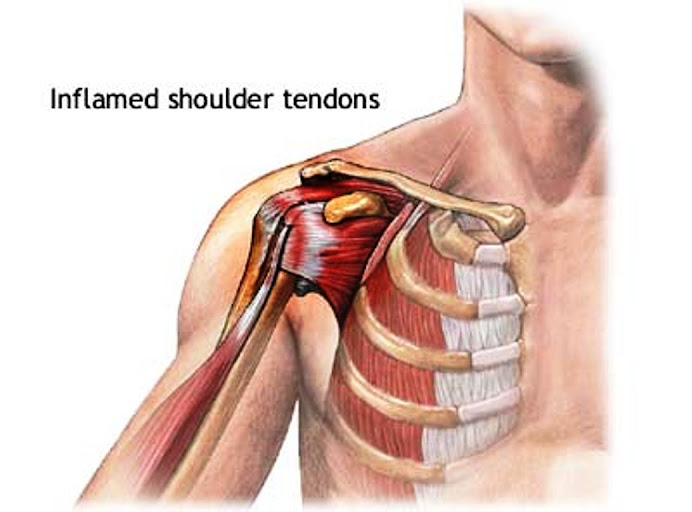 Inflamed shoulder tendons
