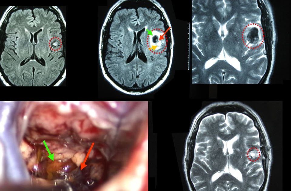 Neurokirurgia: CAVERNOMA