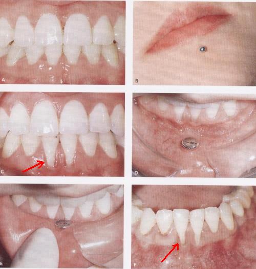 PIERCING EM TECIDOS MOLES DA piercing no dente. PIERCING EM TECIDOS MOLES DA
