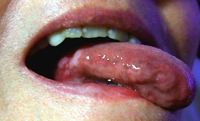 Blister On Tongue