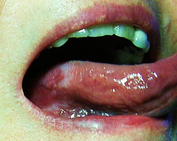 Pictures Of Thrush On Back Of Tongue