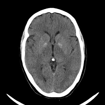 basal ganglia calcification, possible fahrs syndrome