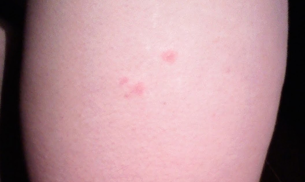 'Bugs News More Mysterious Bites at Night After Moving Into New House