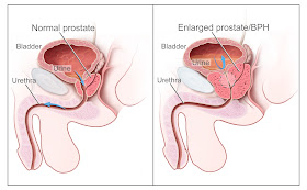 Prostate Cancer Treatment