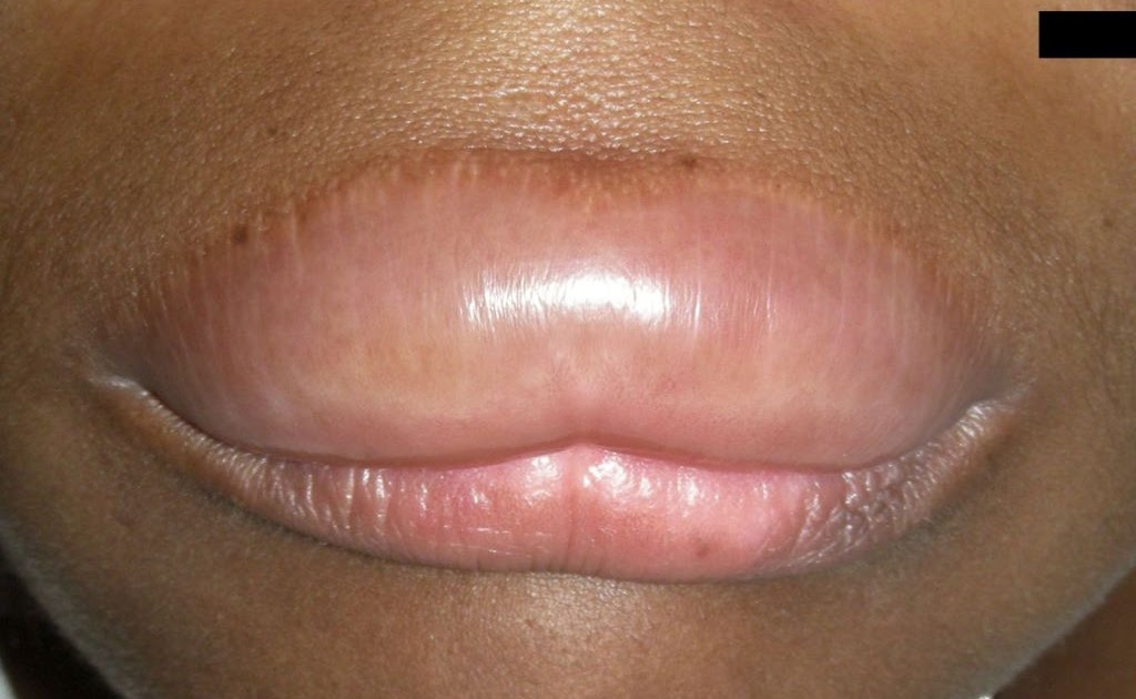 What are some common treatments for angioedema of the lips?