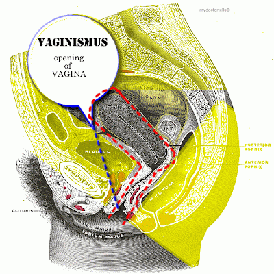 vaginismus_animated_picture