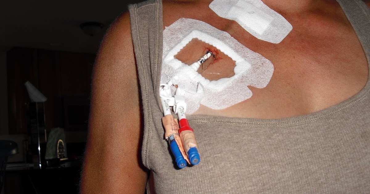 Stem Cell Transplant Multiple Myeloma 9/17/2010 Tunneled Central