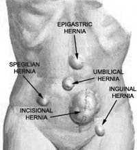 hernia location diagram kerana allah angin pasang kipas tak pasang hernia location diagram kerana allah angin pasang kipas tak pasang
