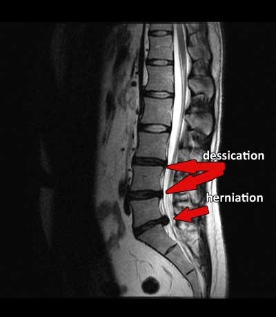 L5-S1 Disc Herniation & Dessication - What is it?