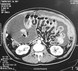 2.- MESOTELIOMA PERITONEAL MALIGNO