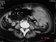 2.- PLASTRÓN DIVERTICULAR