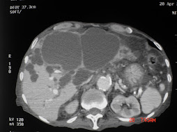 3.- POLIQUISTOSIS HEPÁTICA Y RENAL