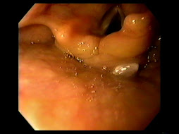 1.- NEOPLASIA DE HIPOFARINGE