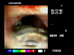 2.- DISFAGIA Y ARTRODESIS CERVICAL