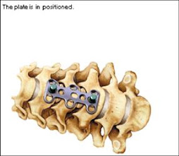 1.- DISFAGIA Y ARTRODESIS CERVICAL