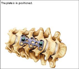 1.- DISFAGIA Y ARTRODESIS CERVICAL